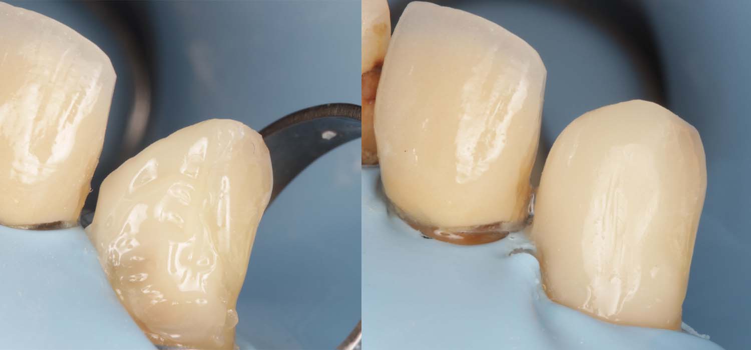 Composite Case 2 Phillips & Co Cosmetic Dentistry Dentist in